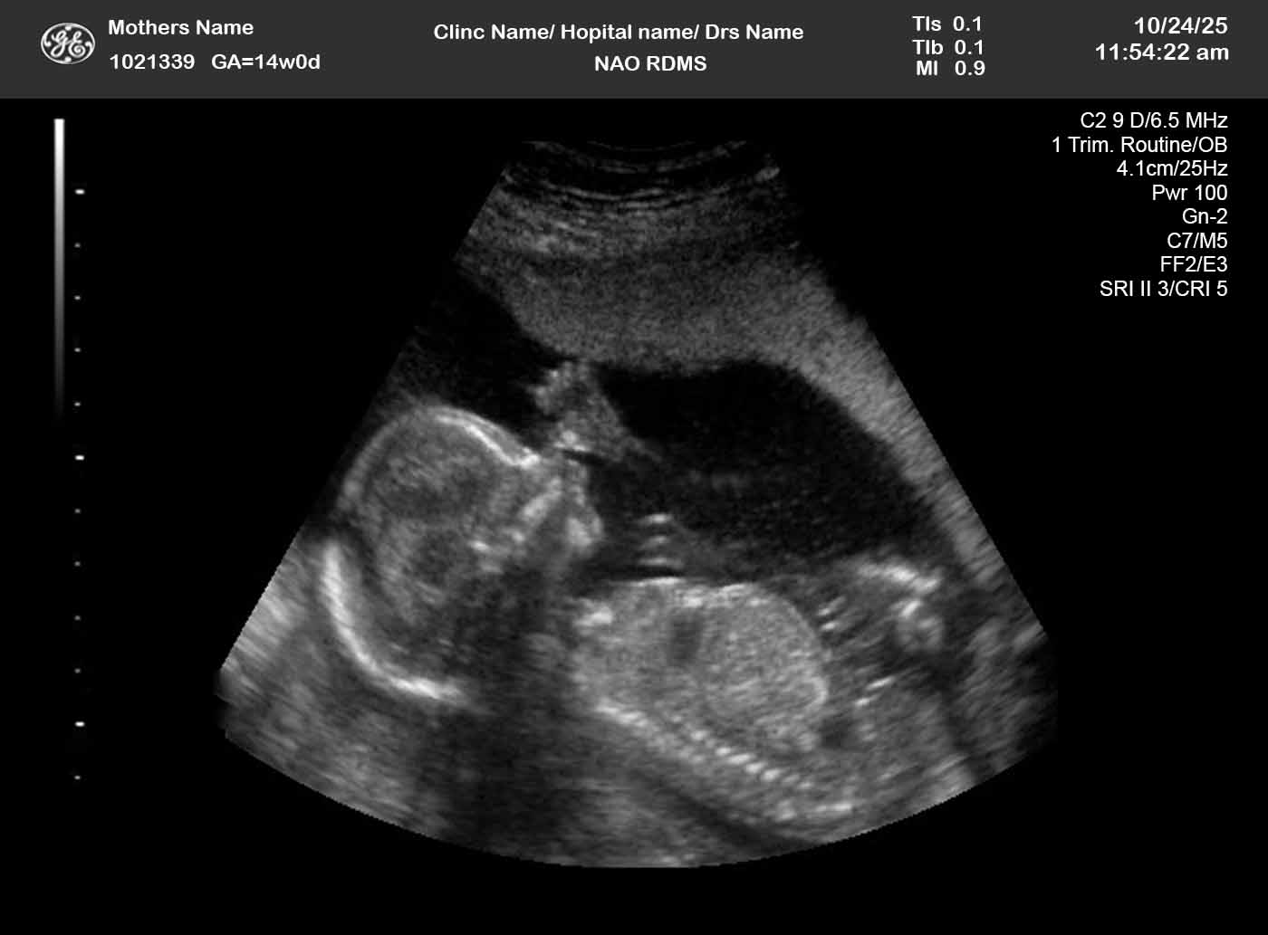 Twin pregnancy
